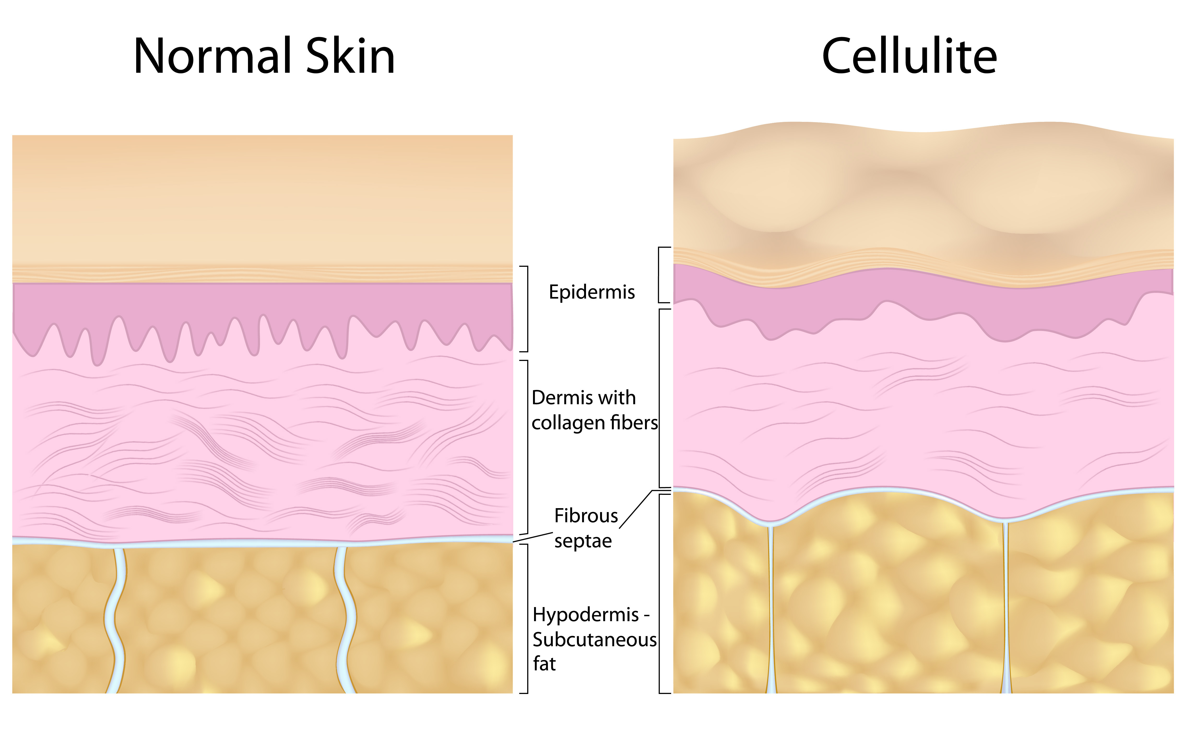 Difference between Normal Skin and Cellulite